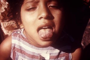 Scurvy may also cause an inflammation of the tongue and submucosal hemorrhaging, a condition termed scorbutic tongue.
