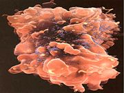 Virus Infected tumor cell Source